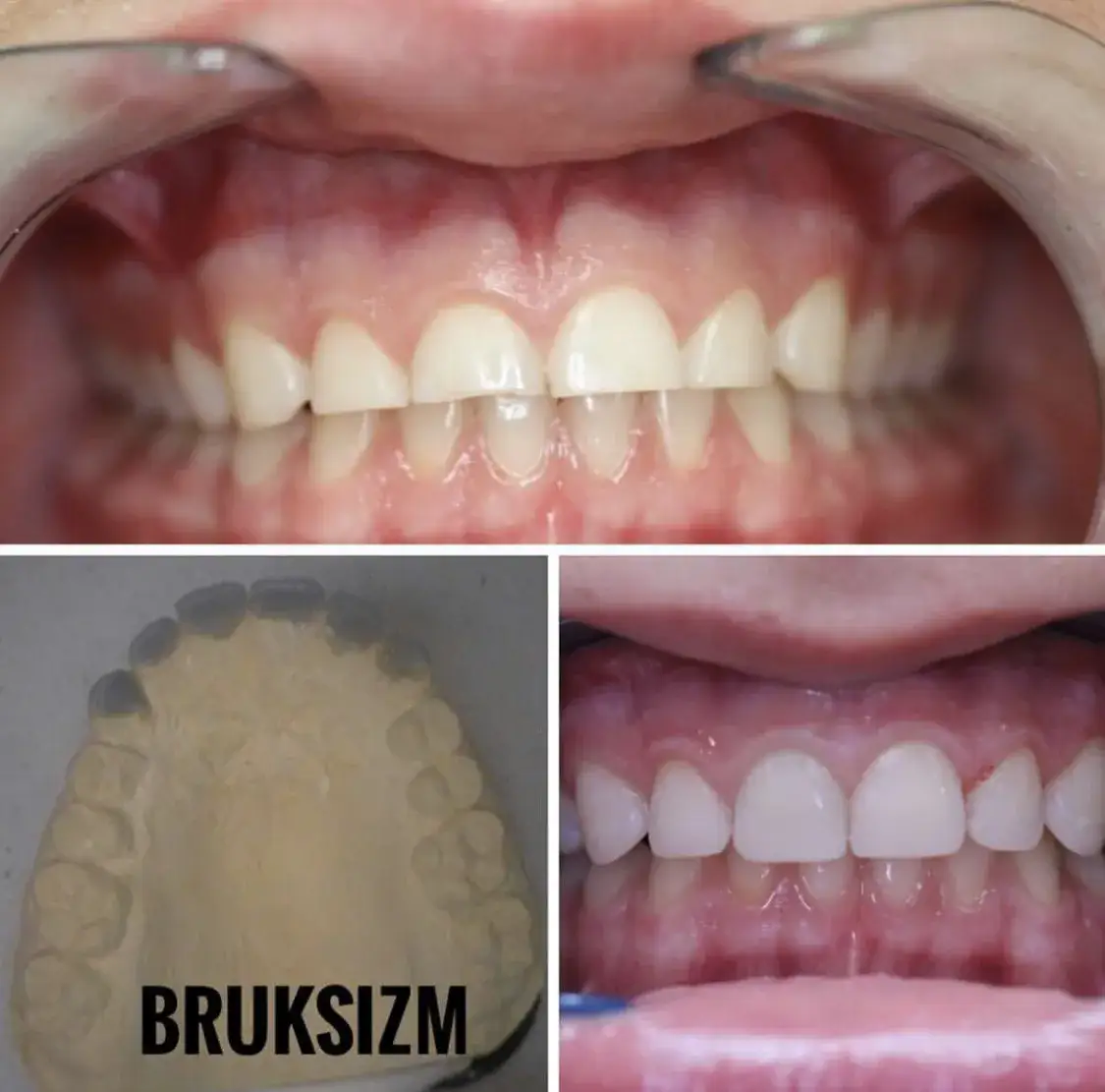 bruksizm objawy