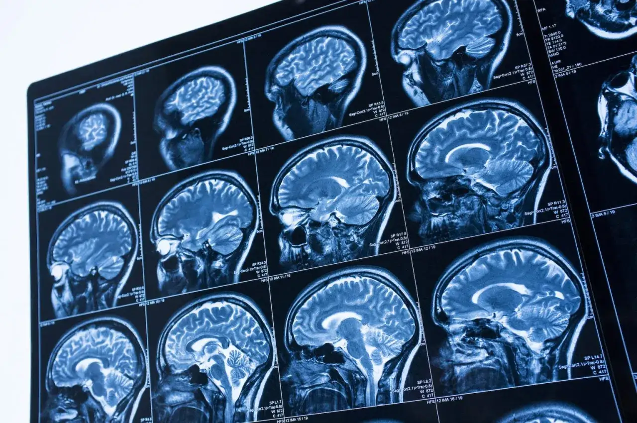 Przekroje mózgu na obrazach rezonansu magnetycznego. Analiza obrazów pozwala ocenić ewentualne skutki uboczne rezonansu magnetycznego.