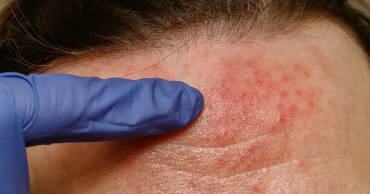 Sk&oacute;ra z zaczerwienieniem i krostkami, badana w rękawiczce. Może to być objaw nużeńca.