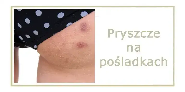 różne rodzaje pryszczy na skórze pośladków infografika