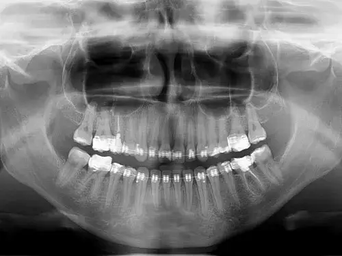 rentgen stomatologiczny pantomogram