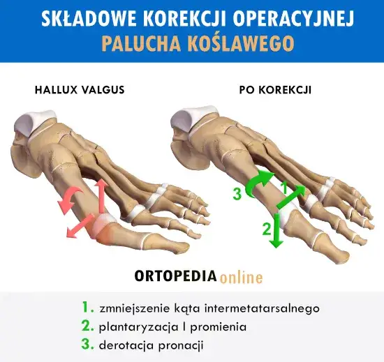 Metody operacji haluks&oacute;w schemat