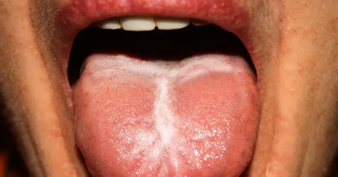 Język z białym nalotem i zaczerwienieniem, mogące być objawy białaczki w jamie ustnej.