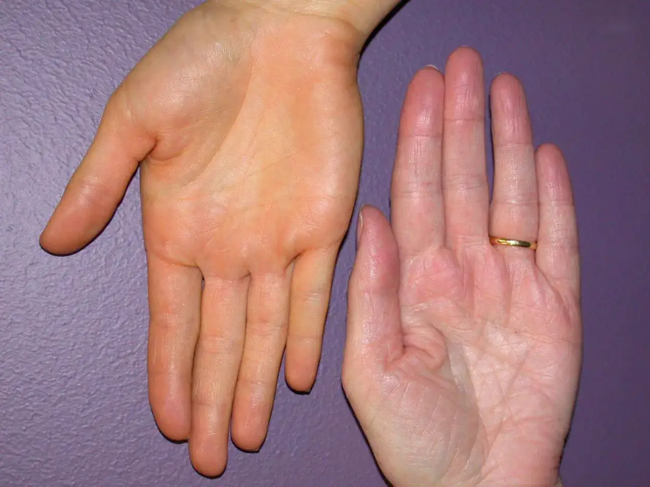 Dwie dłonie na fioletowym tle. Jedna dłoń ma wyraźne pomarańczowe plamy, druga jest jaśniejsza, z widocznym złotym pierścionkiem.