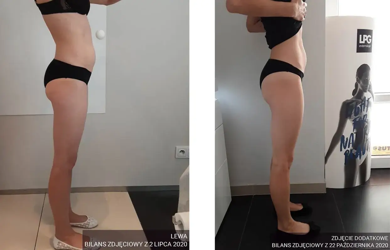 endermologia efekty przed i po