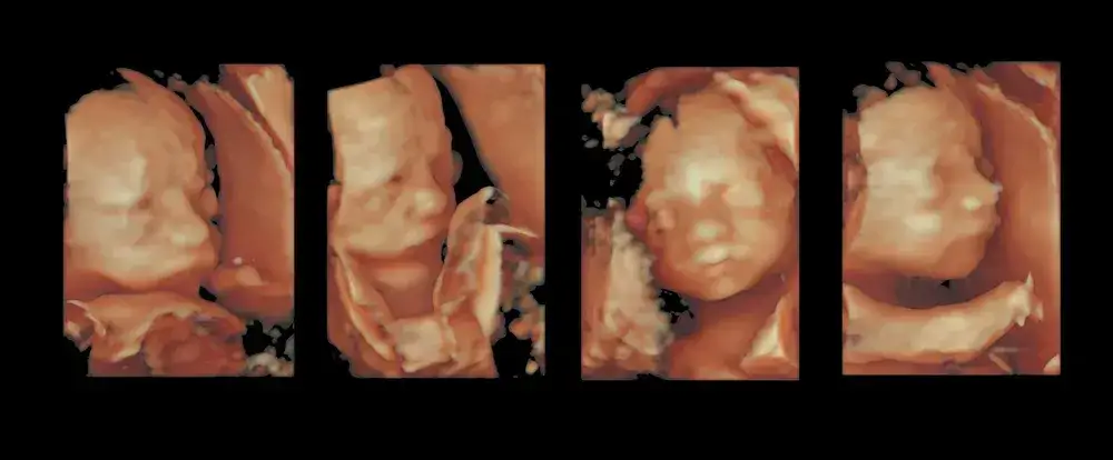 USG trzeciego trymestru ciąży