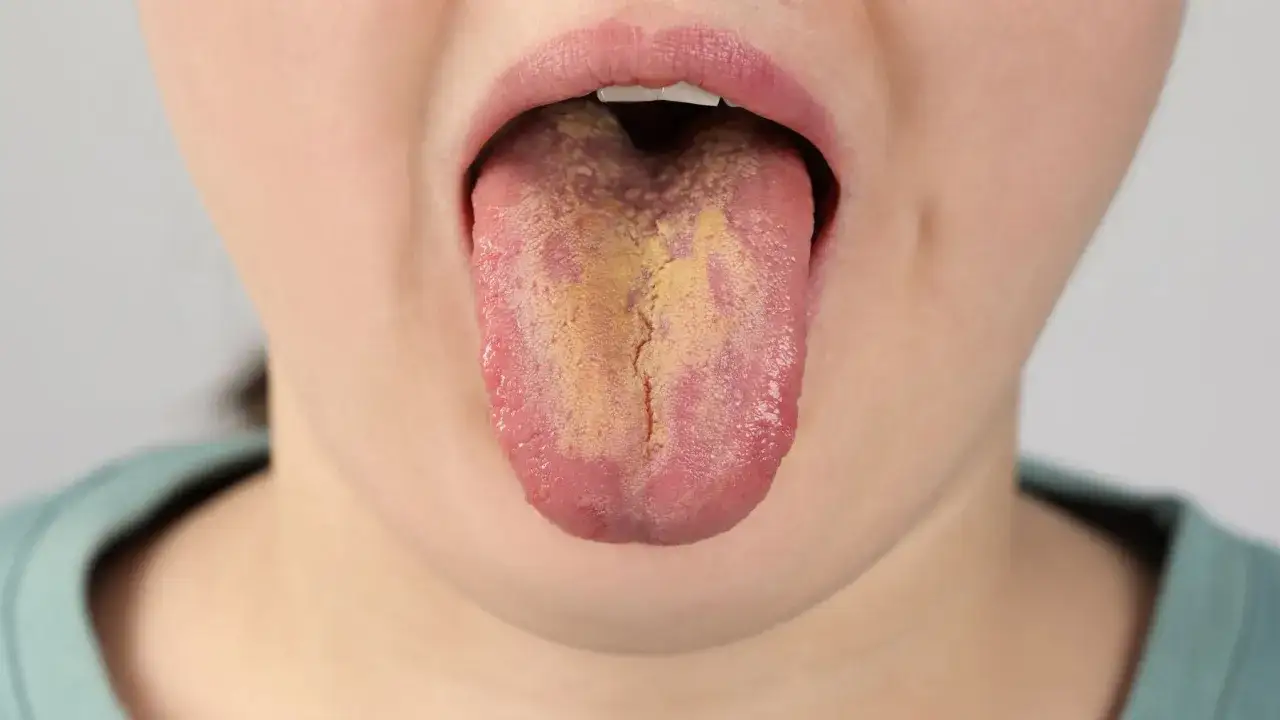 Język dziecka pokryty żółtym nalotem, objaw bakteryjnego zapalenia jamy ustnej.