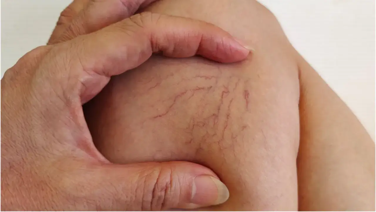 Dłoń dotyka sk&oacute;ry z widocznymi pajęczynami naczyń krwionośnych. Dowiedz się, jak wzmocnić naczynia krwionośne.