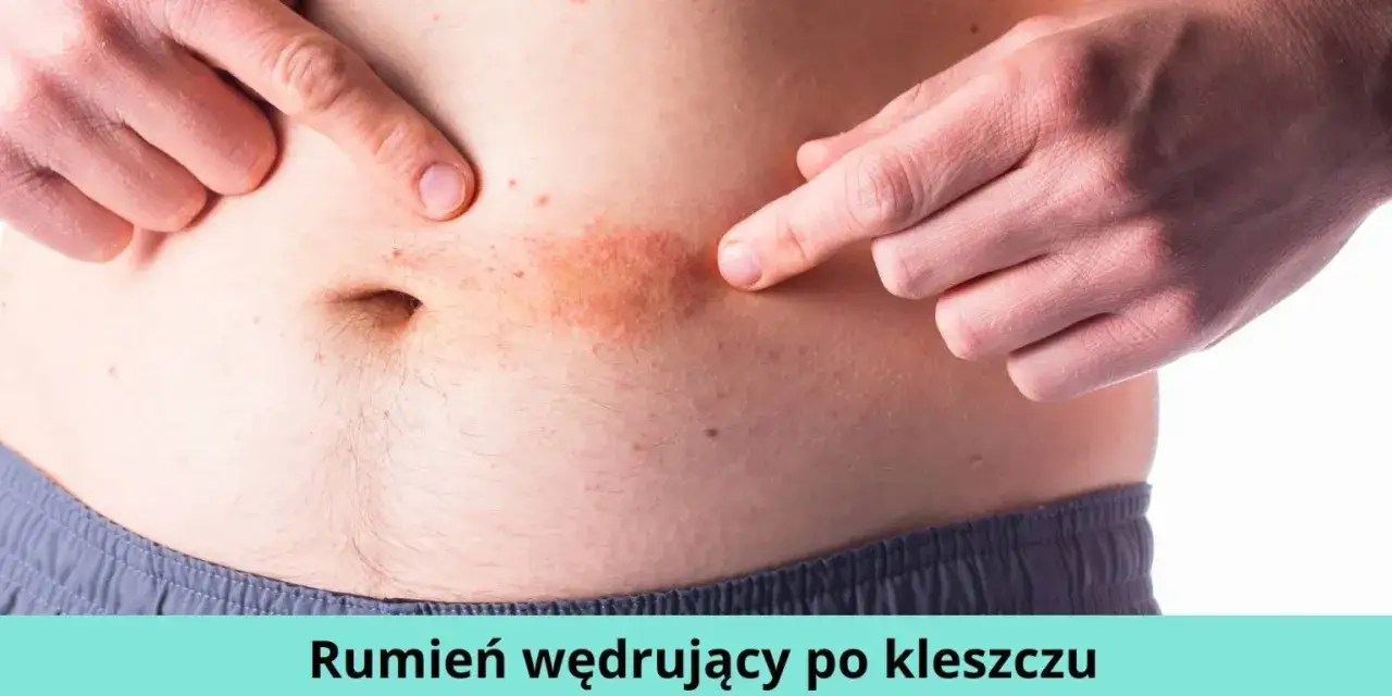 Zdjęcie Jak wygląda rumień po kleszczu? Objawy, które musisz znać, by uniknąć powikłań