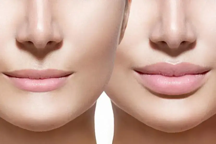 Powiększanie ust kwasem hialuronowym przed i po