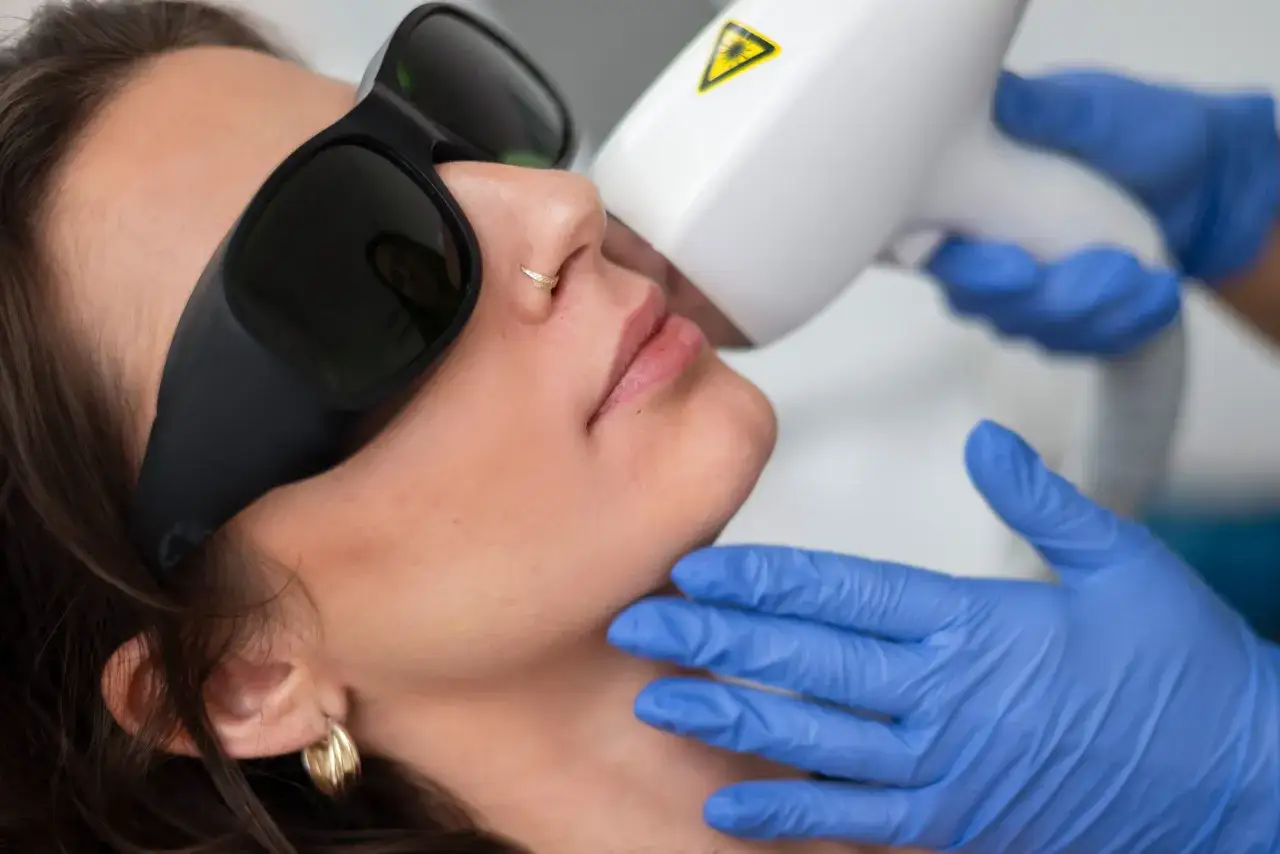 Kobieta w okularach ochronnych przechodzi zabieg depilacji laserowej twarzy. Dłoń w niebieskiej rękawiczce trzyma urządzenie.
