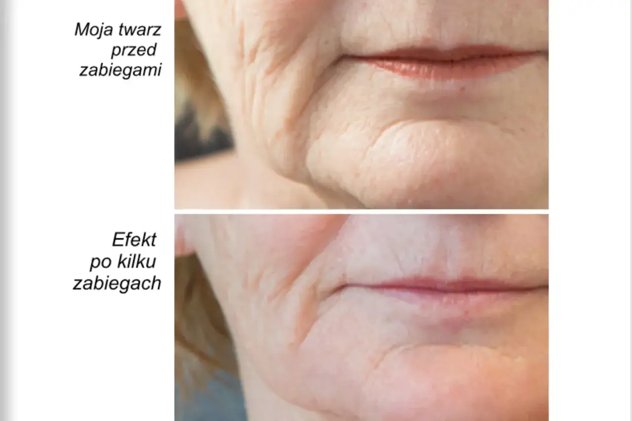 Przed i po zabiegu z użyciem bańki chińskiej do twarzy. Zmarszczki wokół ust są mniej widoczne po kilku zabiegach.