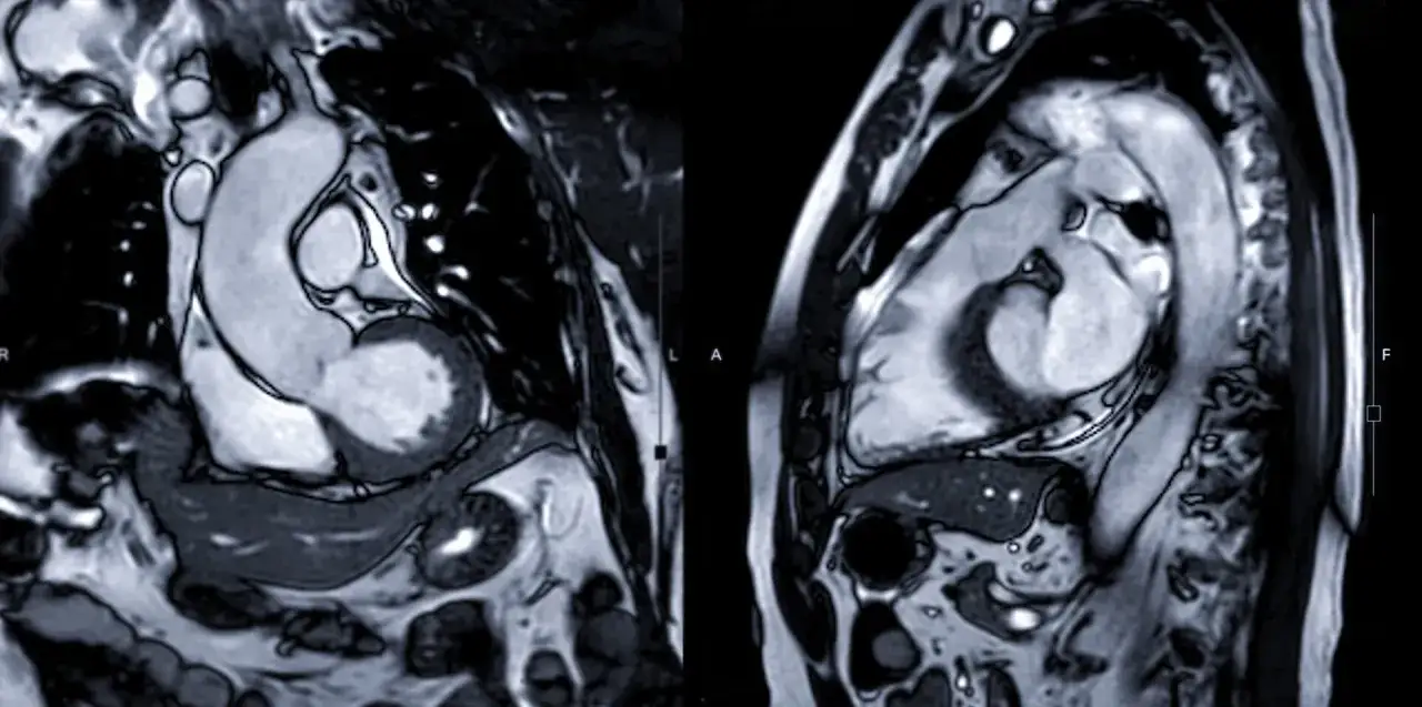 Przekroje serca MRI pokazują przerost mięśnia sercowego, kluczowy dla oceny kardiomiopatii przerostowej rokowania.