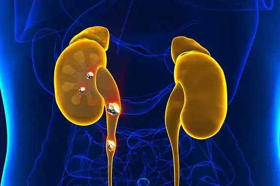 kamienie nerkowe szczawian wapnia