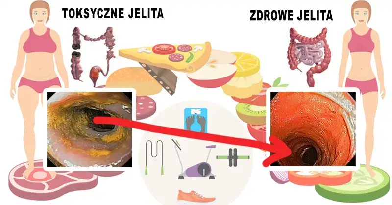 Zdjęcie  Odbudowa flory jelitowej naturalnymi metodami. Jak poprawić kondycję jelit?