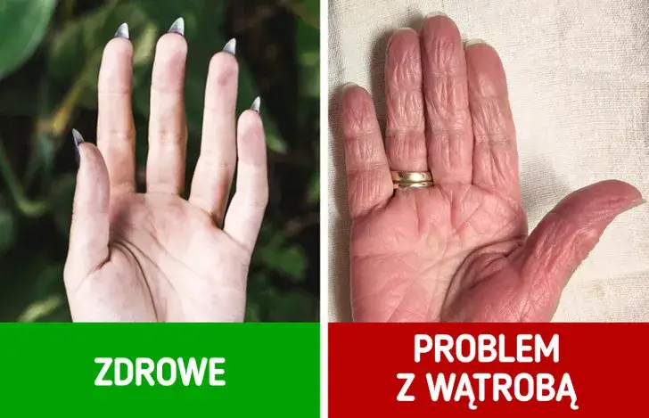Objawy sk&oacute;rne chorej wątroby: ż&oacute;łtaczka, pajączki, rumień dłoniowy