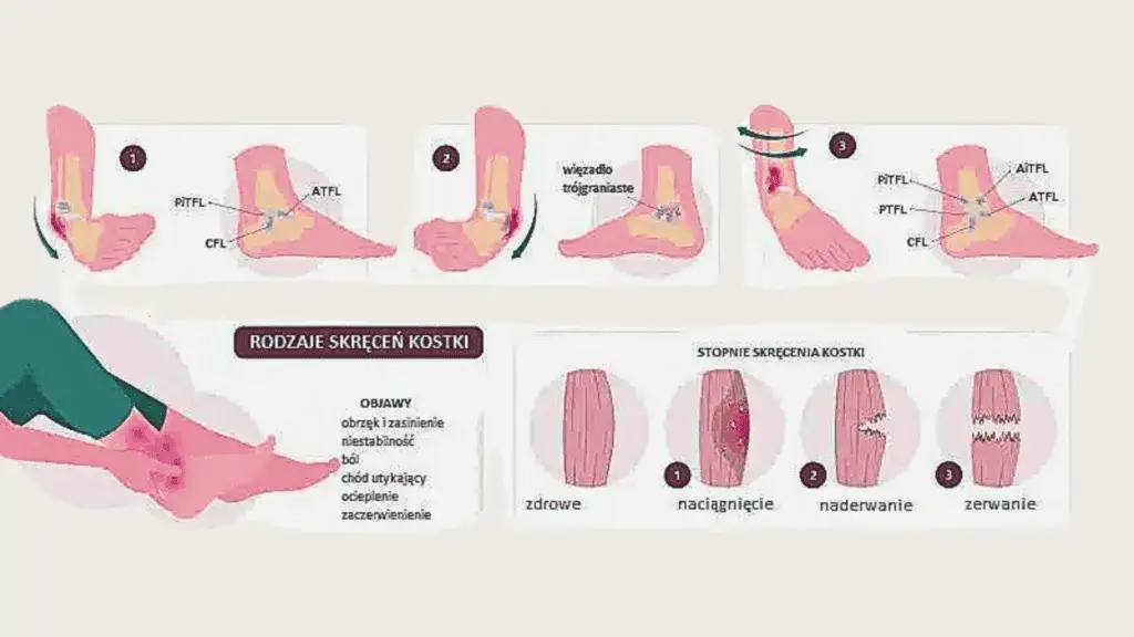 Stopnie skręcenia kostki grafika