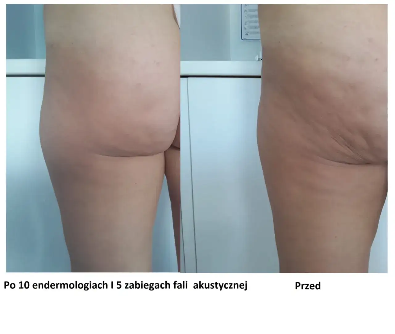 profesjonalne zabiegi na cellulit przed po