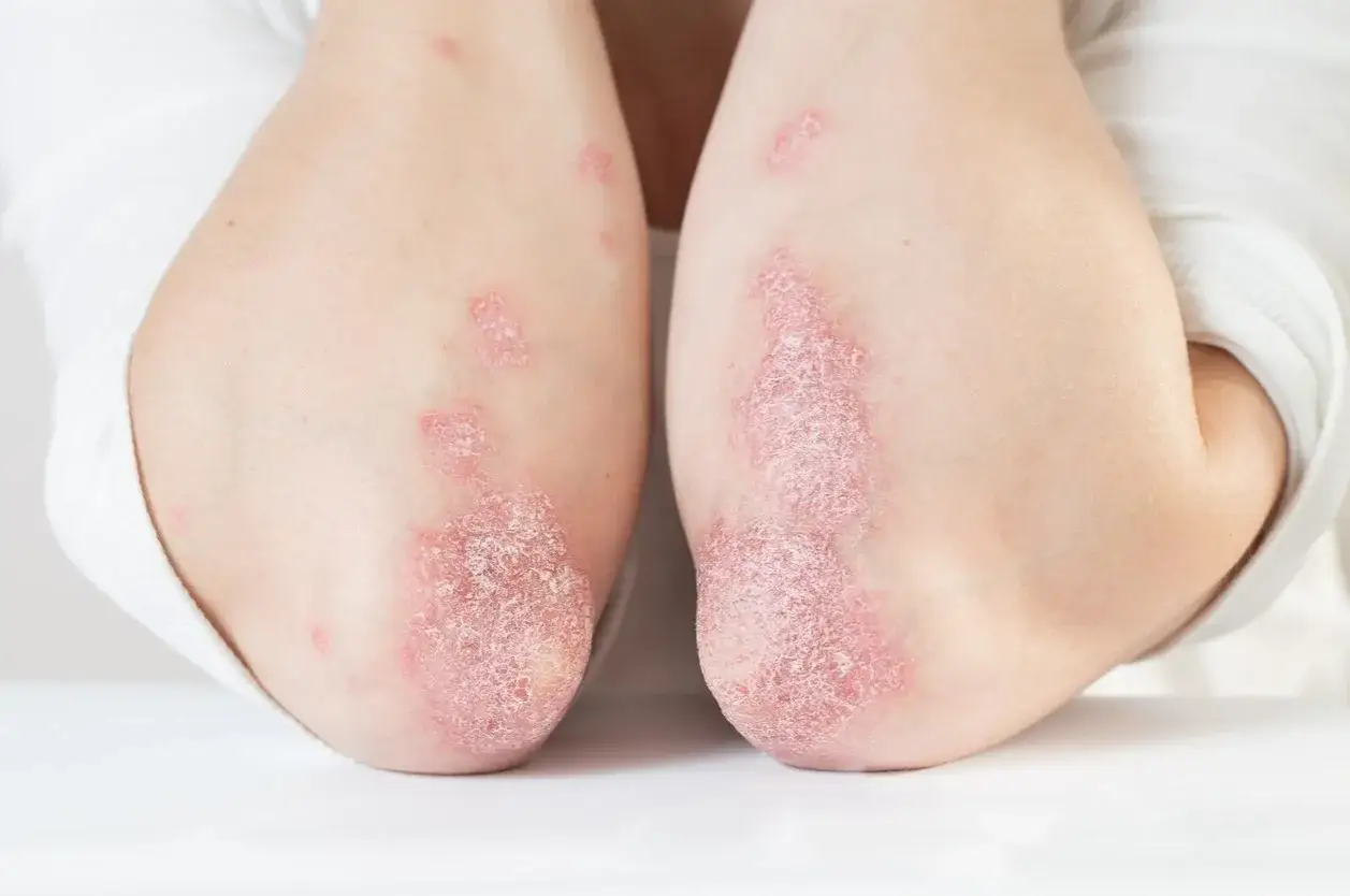 diagnostyka choroby D&uuml;hringa schemat