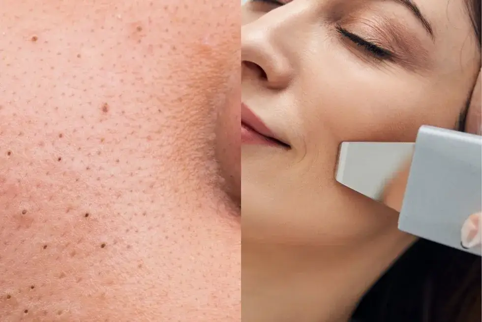 przed i po peeling kawitacyjny efekty