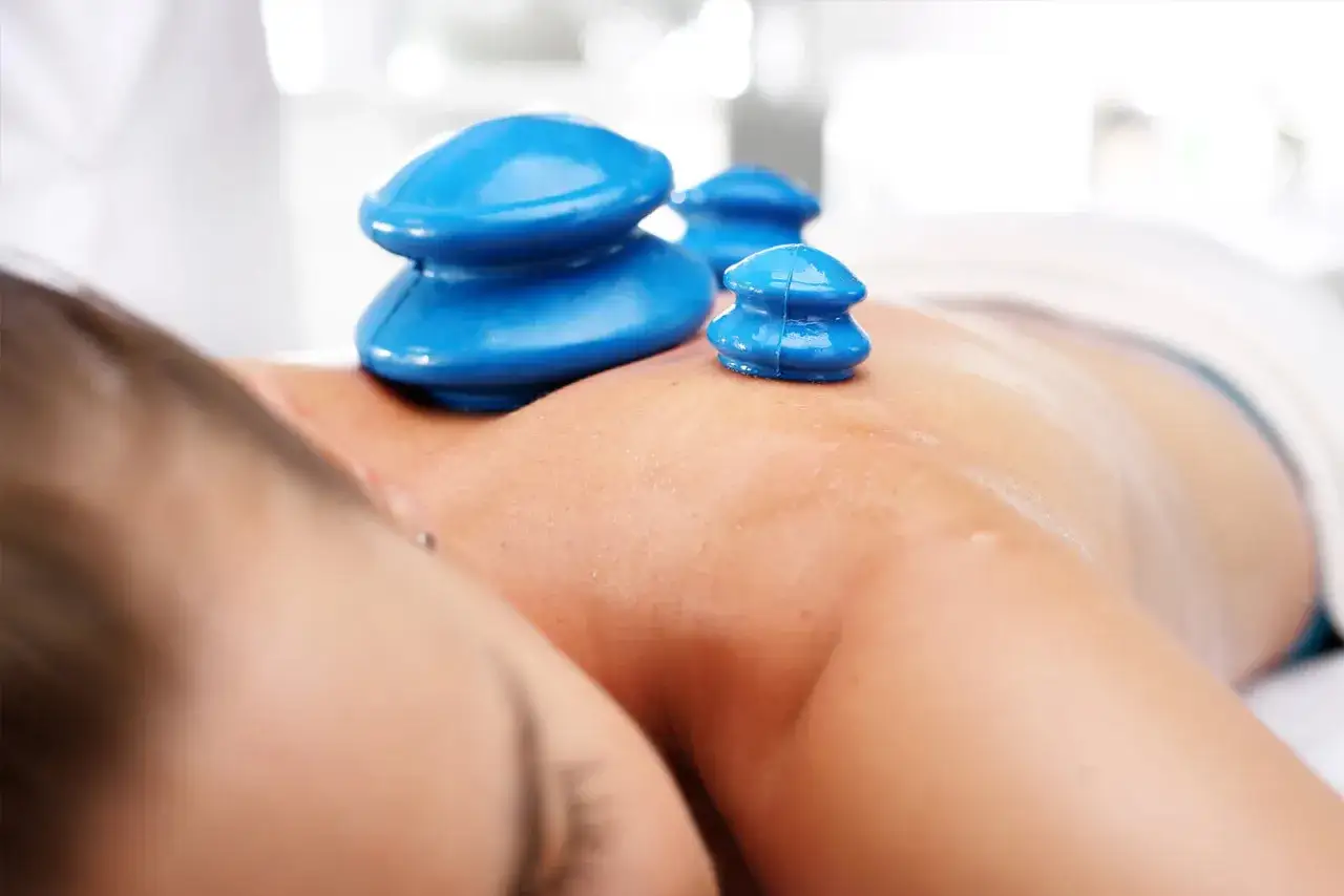 siniaki po masażu bańką chińską