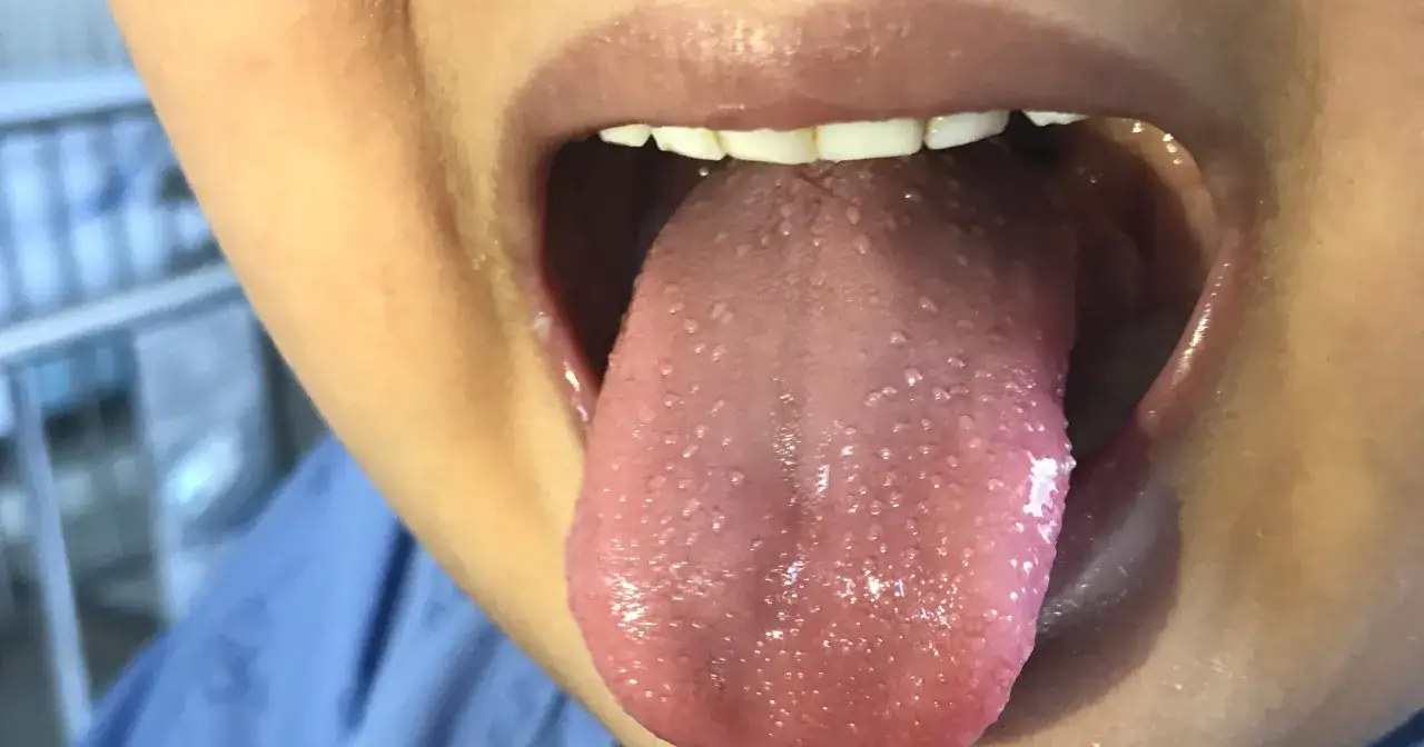 Szkarlatyna u dzieci objawy gardła