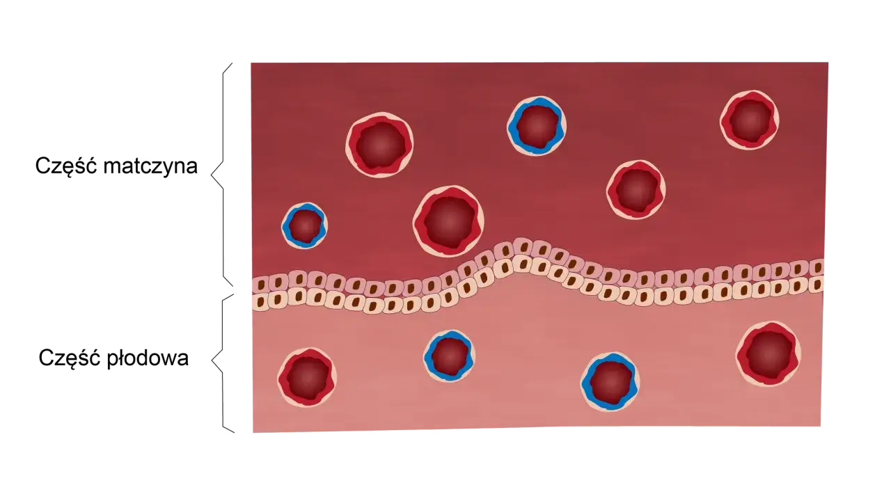 Rodzaje patologii łożyska grafika