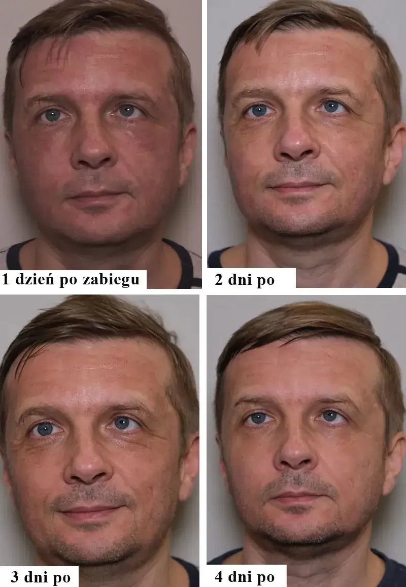 Zdjęcie Kiedy widać efekty po laserze frakcyjnym? Oczekiwane rezultaty i czas