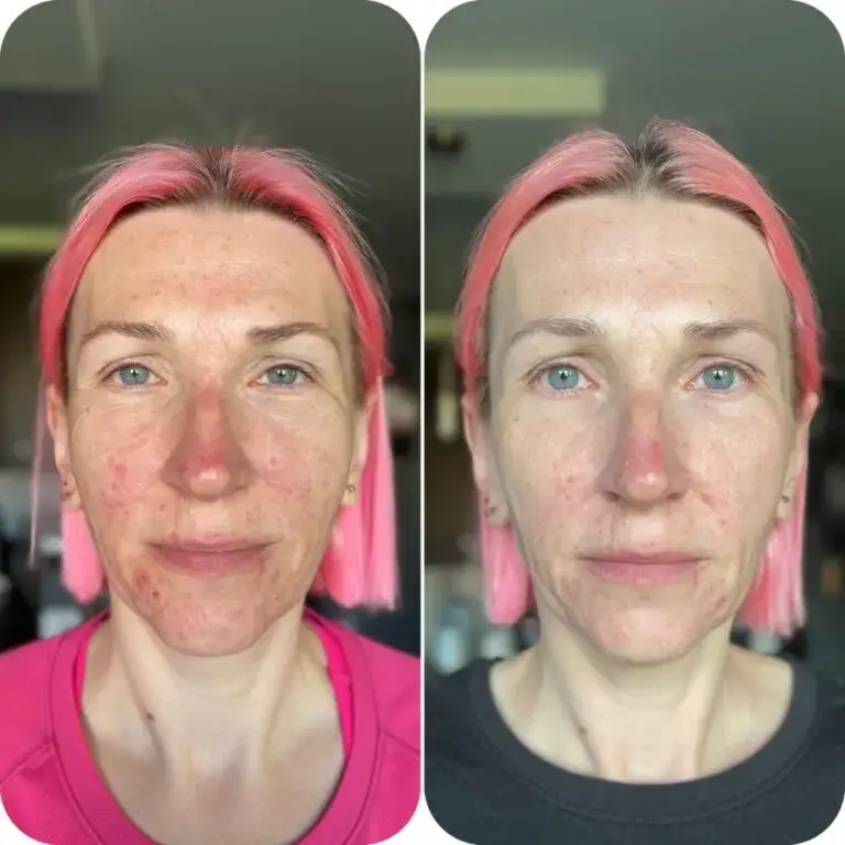 Zdjęcie Najlepsze kremy na niedoskonałości ranking - skuteczne rozwiązania na trądzik