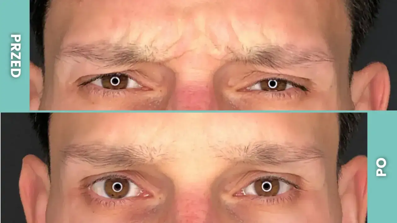 Przed i po: widoczna redukcja lwiej zmarszczki na czole. Skóra wygląda na gładszą i bardziej wypoczętą.