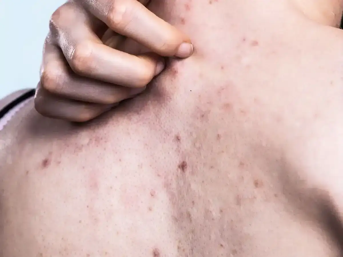 Skóra z widocznym trądzikiem grzybiczym na karku i ramionach. Dłoń drapiąca swędzące zmiany.