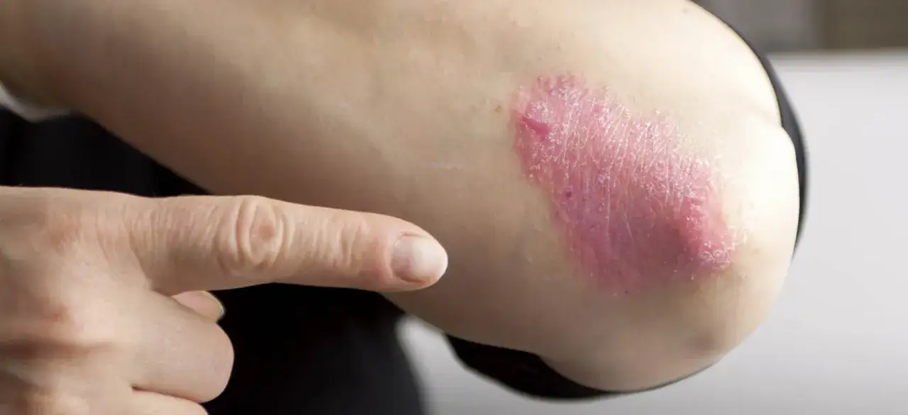 Czerwona, łuszcząca się plama na łokciu, wskazująca na łuszczycę pierwsze objawy.