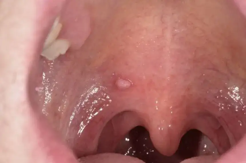 objawy HPV w jamie ustnej brodawki