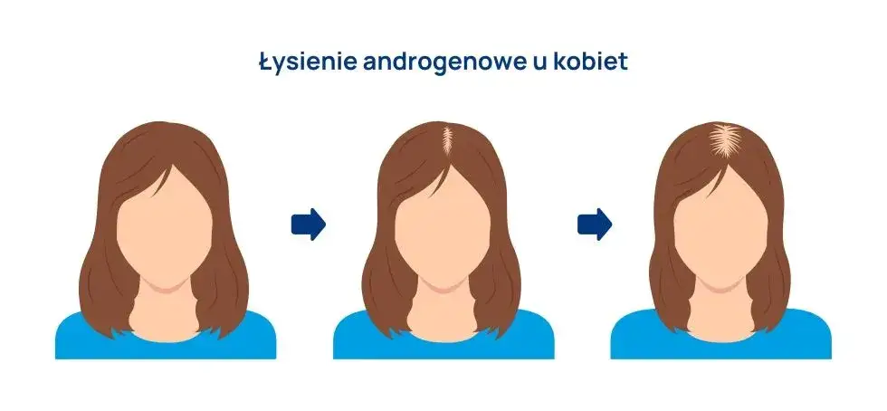 Zdjęcie Łysienie androgenowe u kobiet: objawy, przyczyny i wpływ