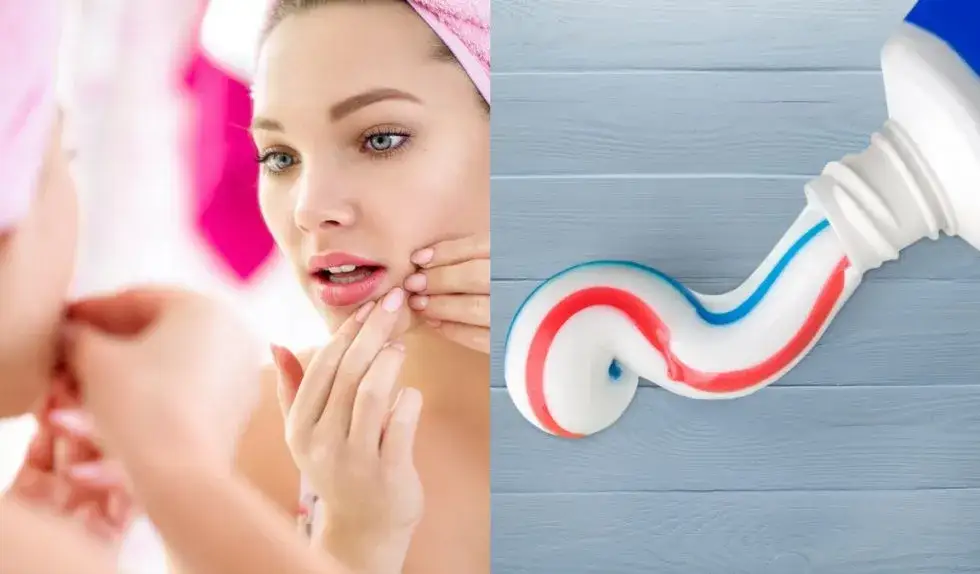 Zdjęcie Czy pasta do zębów wysusza pryszcze? Prawda o skuteczności i ryzyku