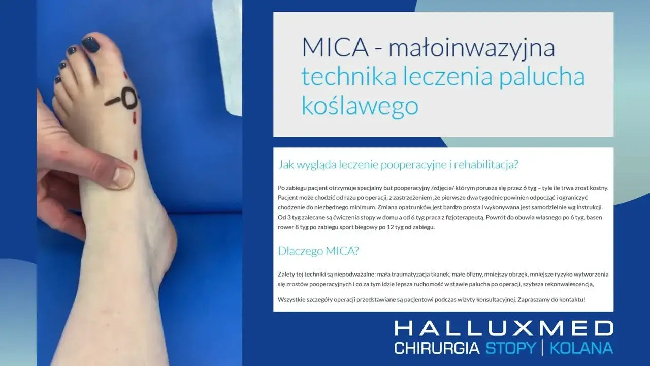 Zdjęcie Jak dbać o stopę po operacji haluksa, aby uniknąć bólu i komplikacji
