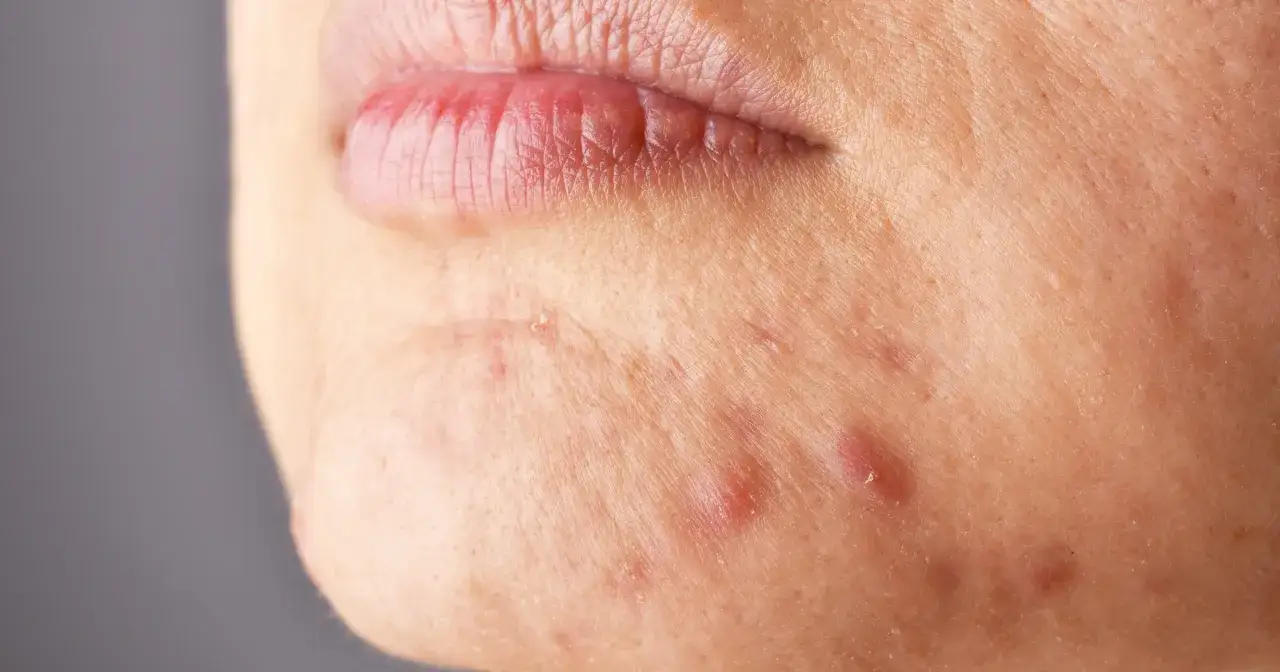 Widoczne zaczerwienione, zapchane pory na skórze, tworzące drobne wypryski i nierówności.