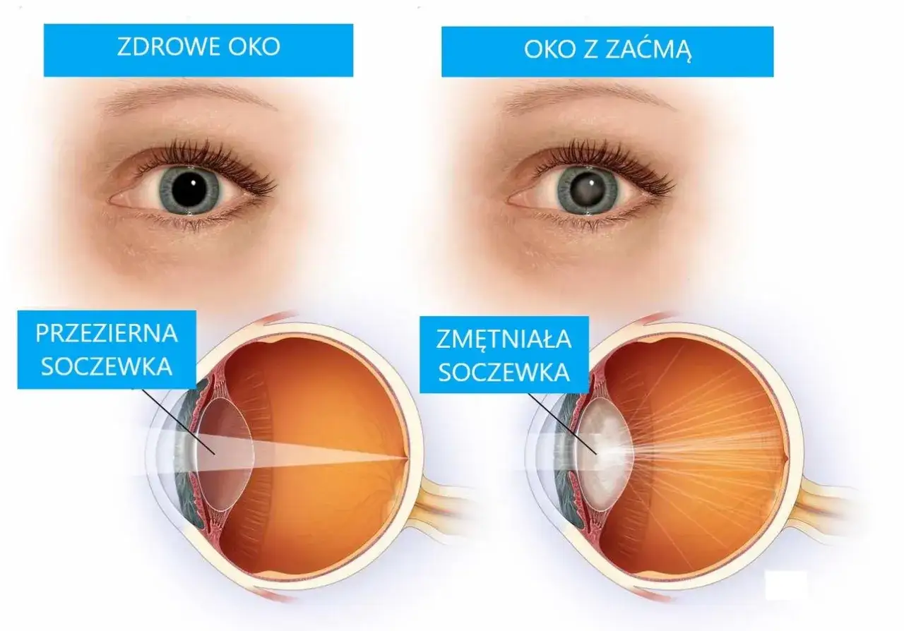 zdrowe oko a oko z zaćmą porównanie