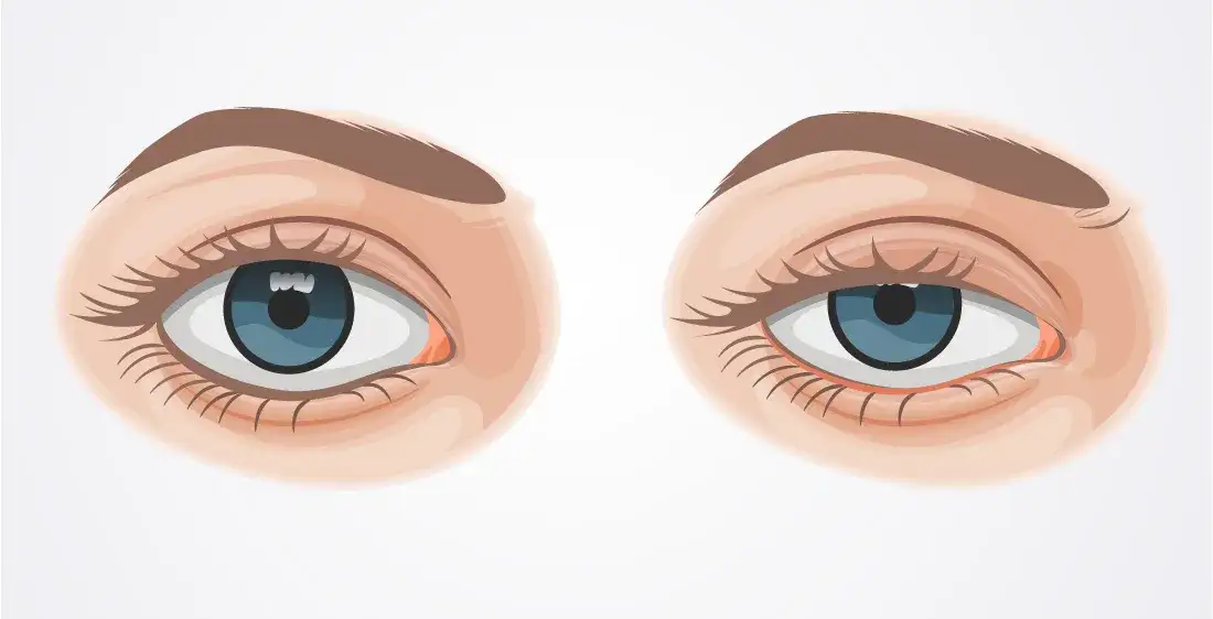 krople do oczu na opadającą powiekę apraklonidyna