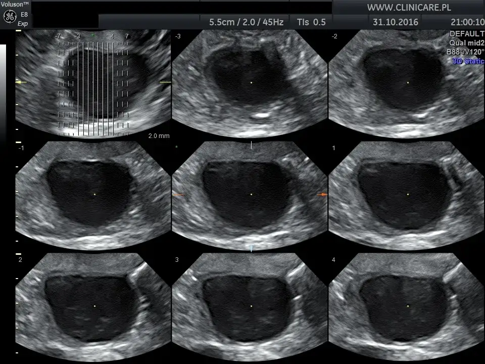 USG dopochwowe obraz