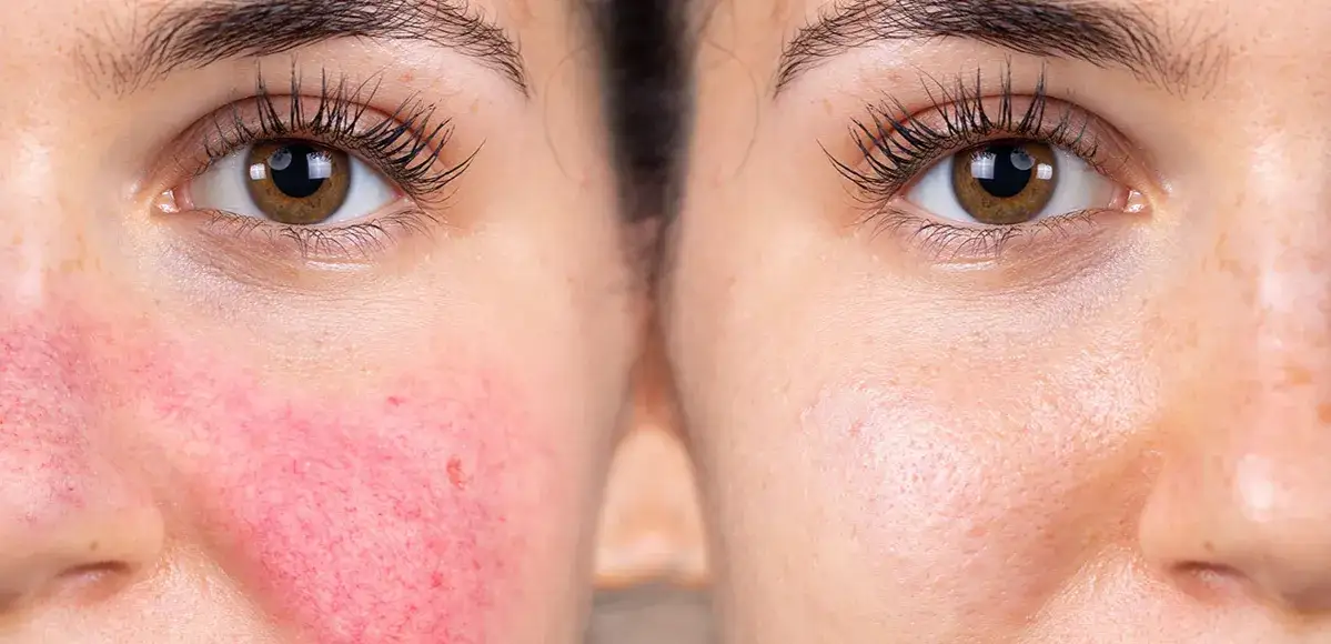 laser naczyniowy na czerwone plamy po trądziku