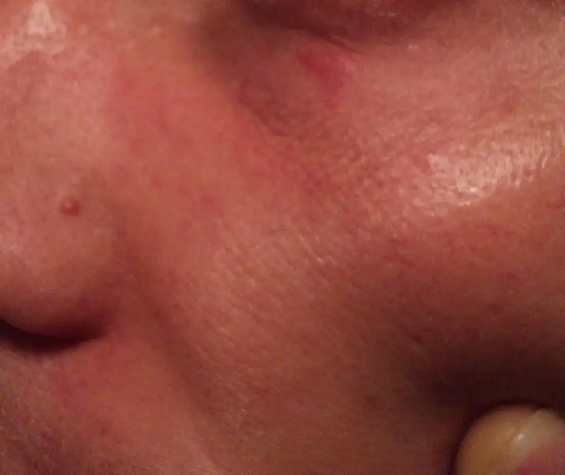 Zdjęcie Dlaczego pryszcze wyskakują w tym samym miejscu? Oto najczęstsze przyczyny