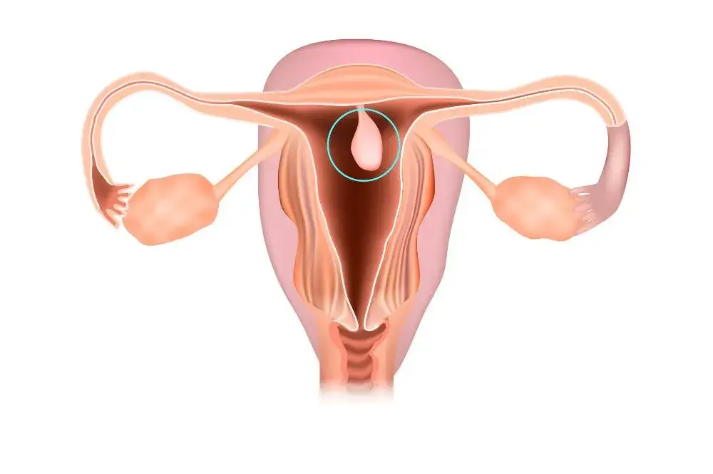 mięśniaki macicy i polipy endometrialne schemat