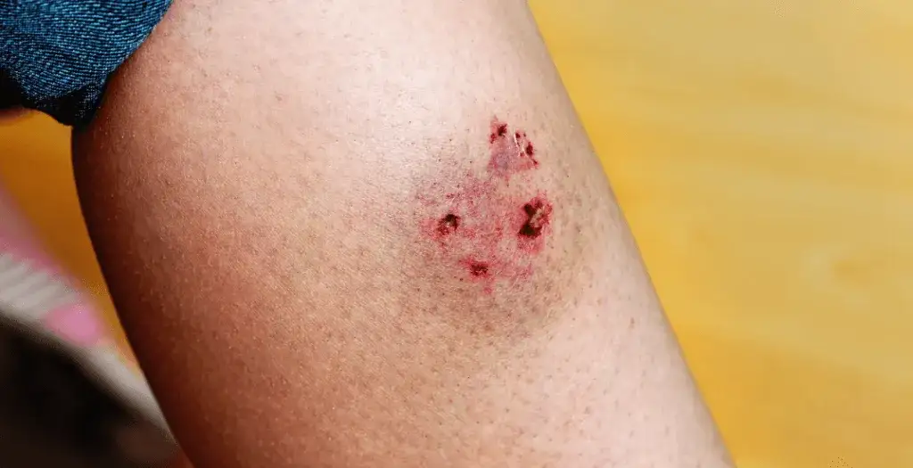 Zdjęcie Qué hacer si me ha mordido un perro: pasos cruciales a seguir