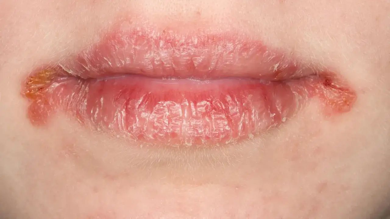 Sk&oacute;ra wok&oacute;ł ust jest zaczerwieniona i sucha, z widocznymi pęknięciami i strupkami w kącikach ust.