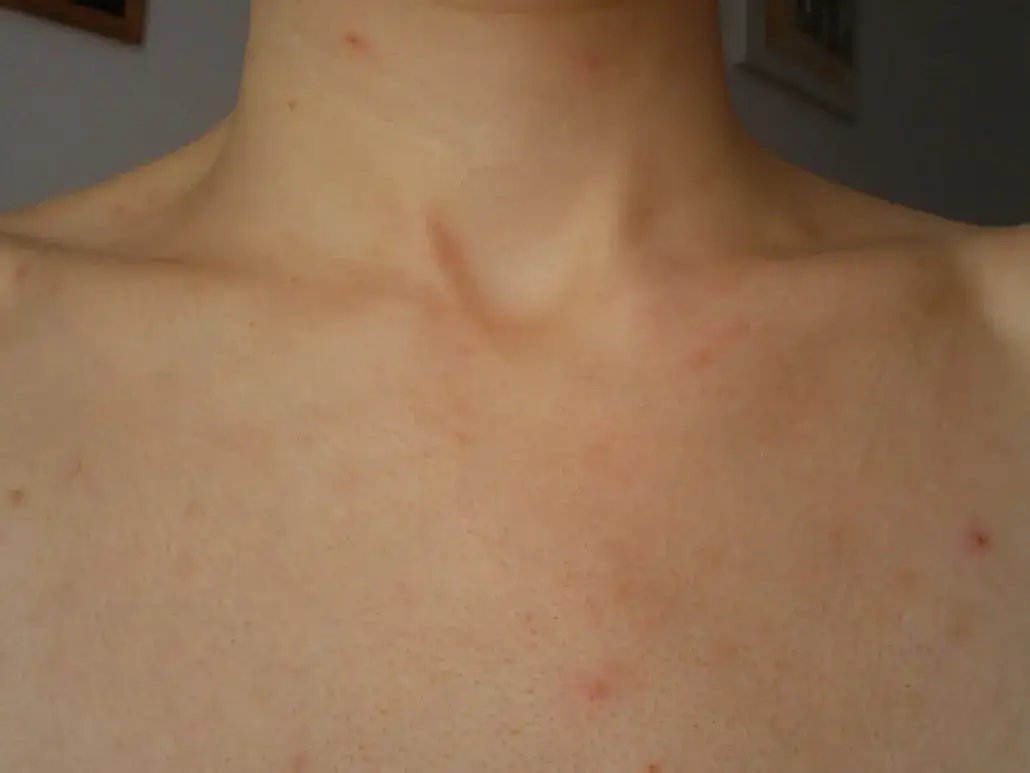 składniki aktywne na pryszcze dekolt