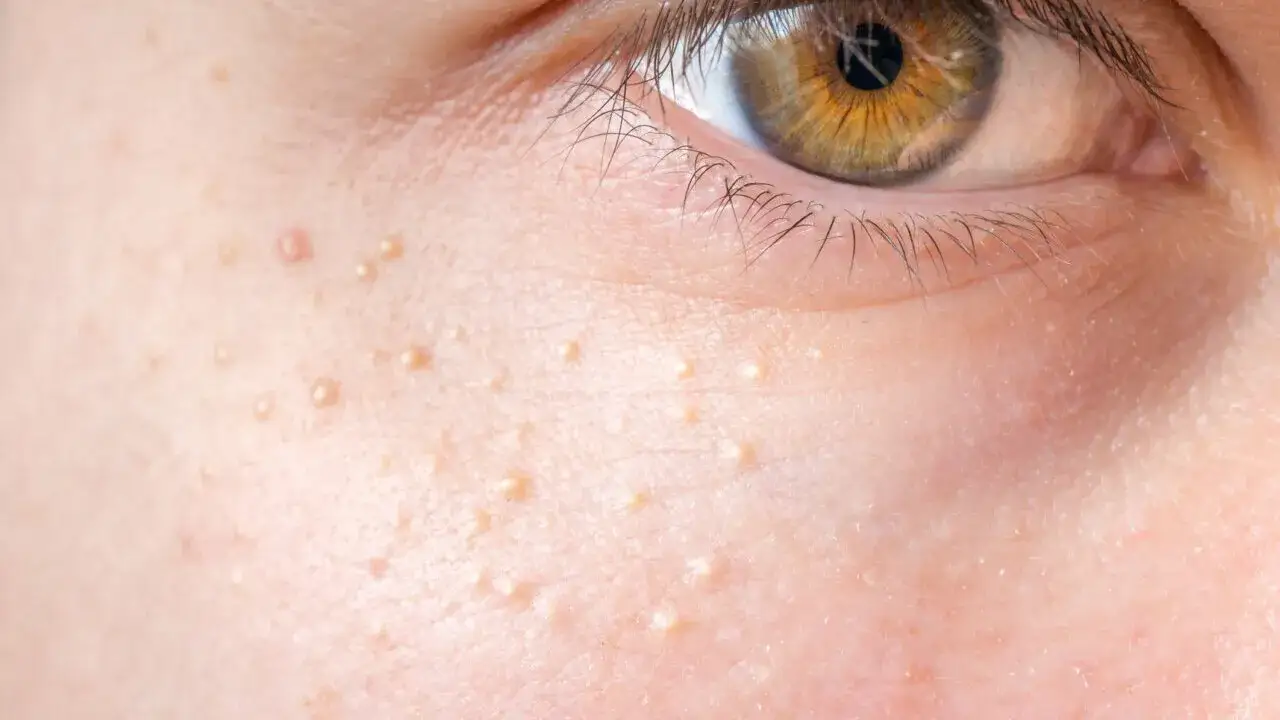 przyczyny zablokowanych porów