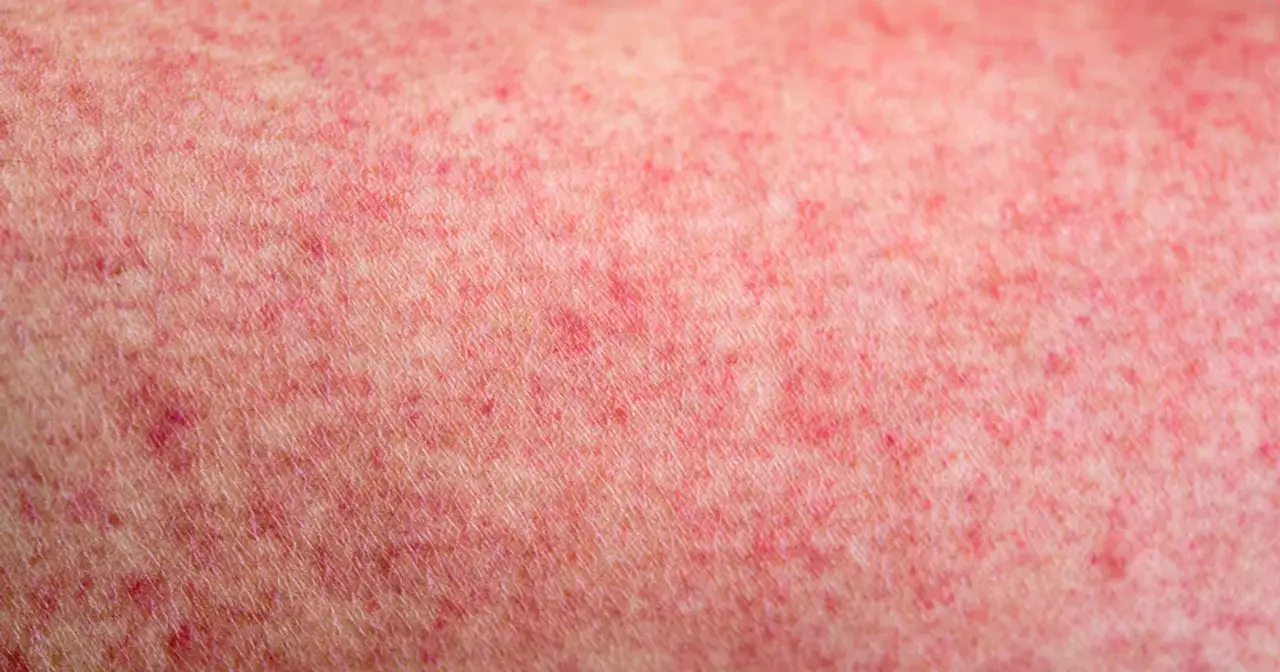 Czerwona wysypka na sk&oacute;rze, kt&oacute;ra może być objawem sepsy. Czas, jak długo rozwija się sepsa, jest zmienny.