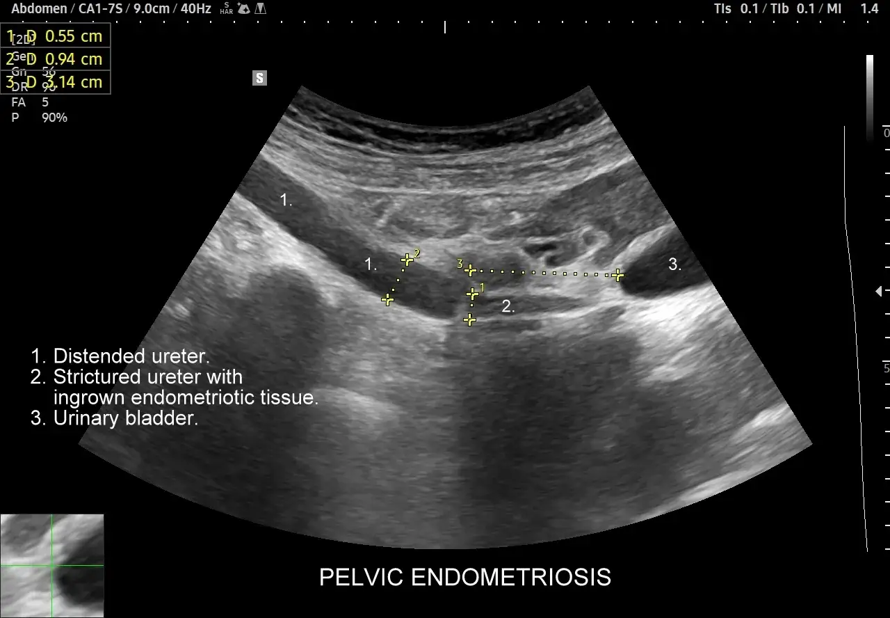 USG obraz jamy brzusznej z widocznym niejednorodnym endometrium, poszerzonym i zwężonym moczowodem z tkanką endometrialną oraz pęcherzem moczowym.