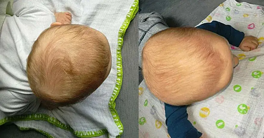 Zdjęcie Poduszka kształtująca główkę od kiedy - uniknij deformacji czaszki dziecka